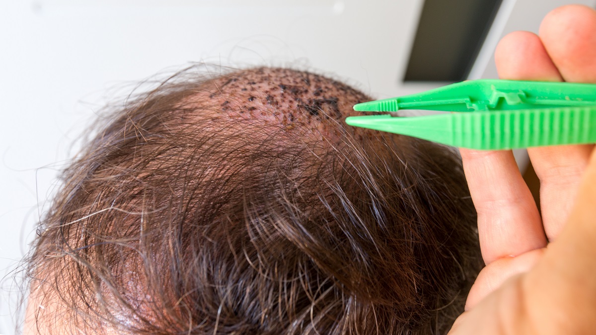 Trasplante capilar: técnica y efectos