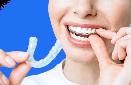 Beneficios de la ortodoncia invisible: Sonrisa perfecta sin brackets