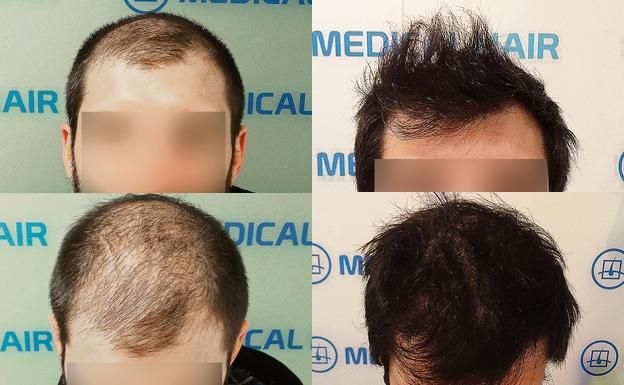 Mesoterapia capilar: el secreto para un cabello más fuerte y con más volumen