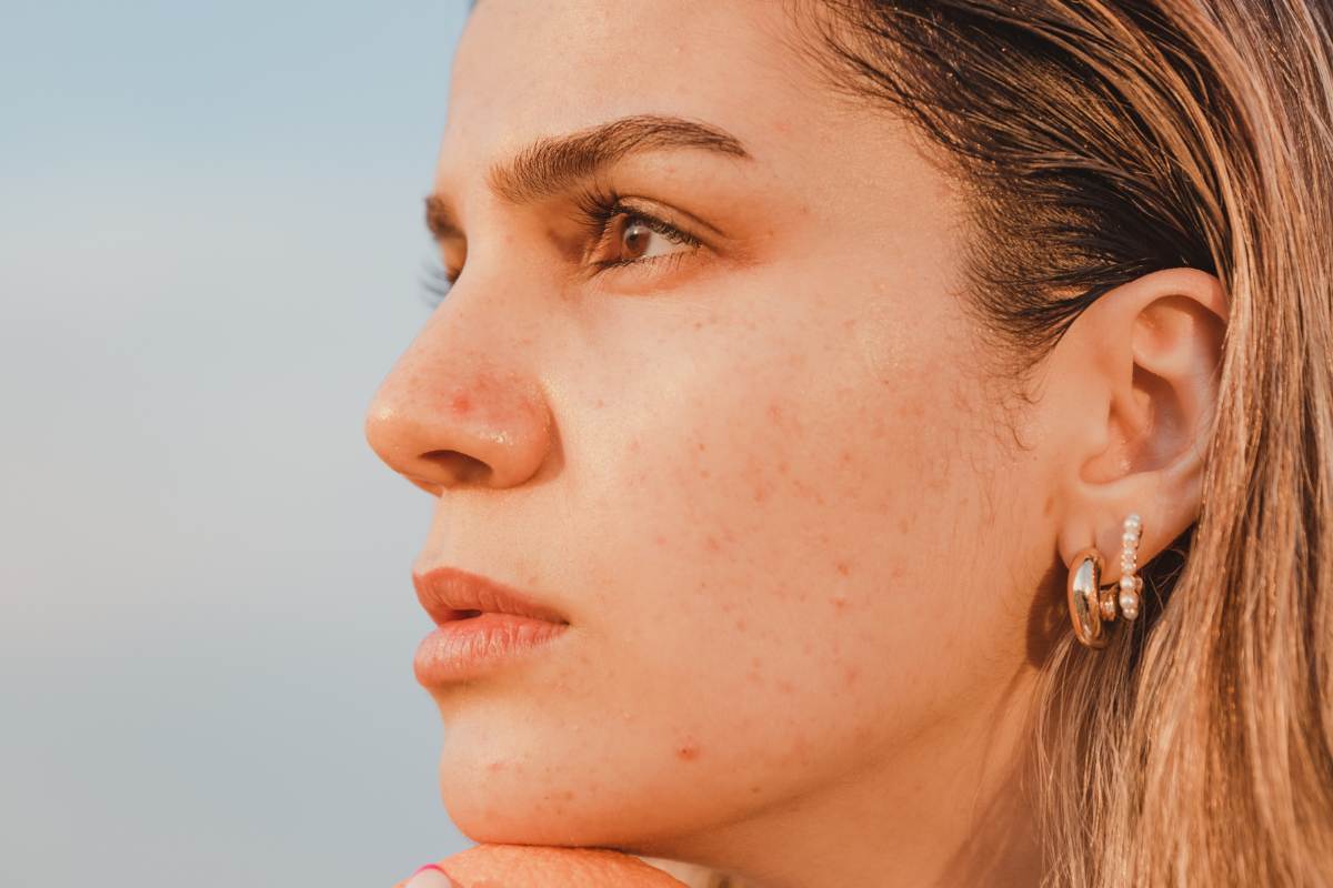Brotes de granos en la cara, ¿Cuáles son las causas y cómo acabar con ellos?