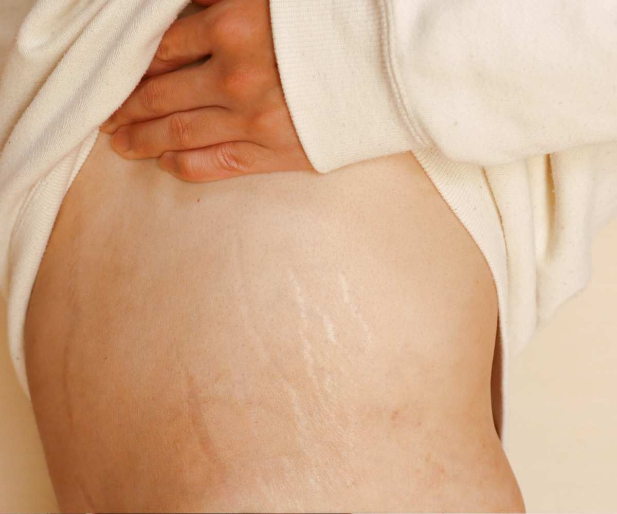 Cómo quitar las estrías